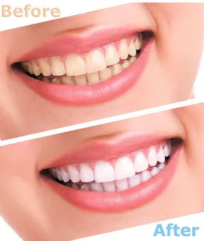 44% karbamido peroksido 10ml dantų balinimo gelis/dantų balinimo gelis švirkštų dantų balinimo droshipping